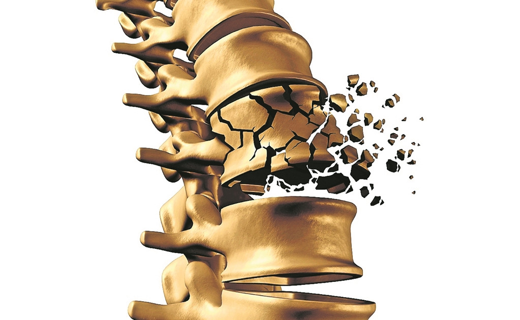 Osteoporoz