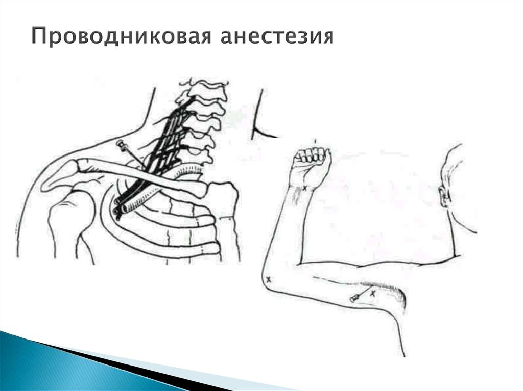 Pro-provodnikovuyu-anesteziyu