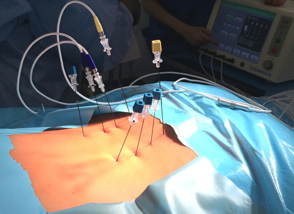 Radiochastotnaya-denervaciya-pri-lechenii-boli-v-spine